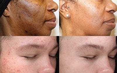 TDC is now offering the VI Chemical Peel