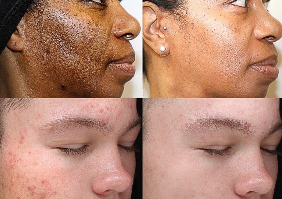 TDC is now offering the VI Chemical Peel